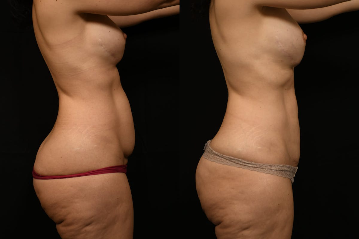 Liposuction / BodyTite Before & After Gallery - Patient 285479 - Image 5