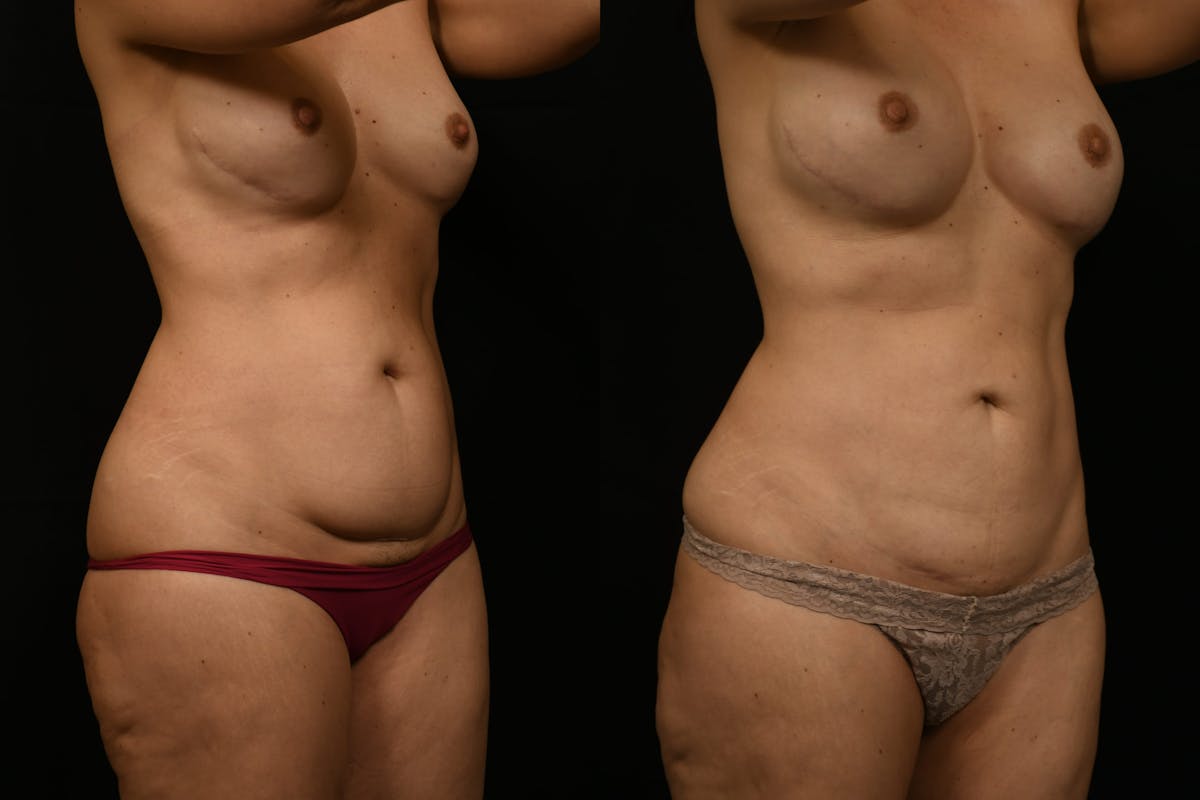 Liposuction / BodyTite Before & After Gallery - Patient 285479 - Image 4