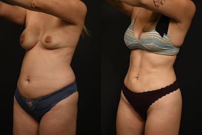 Liposuction / BodyTite Before & After Gallery - Patient 121170 - Image 1
