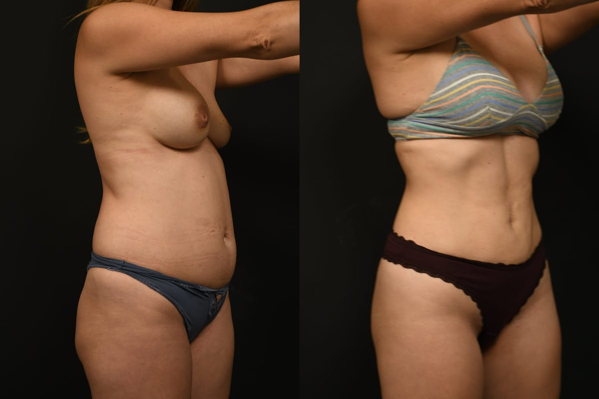 Liposuction Before & After Gallery - Patient 121170 - Image 3