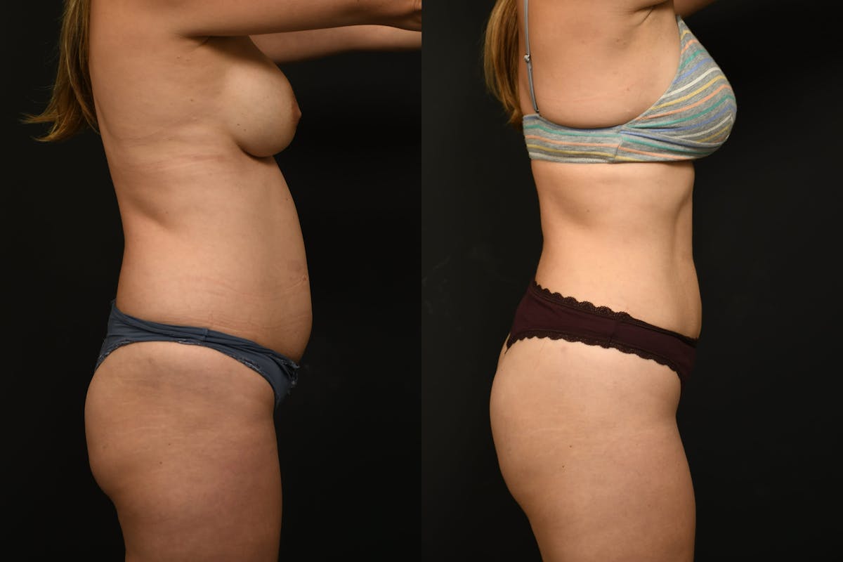 Liposuction / BodyTite Before & After Gallery - Patient 121170 - Image 4