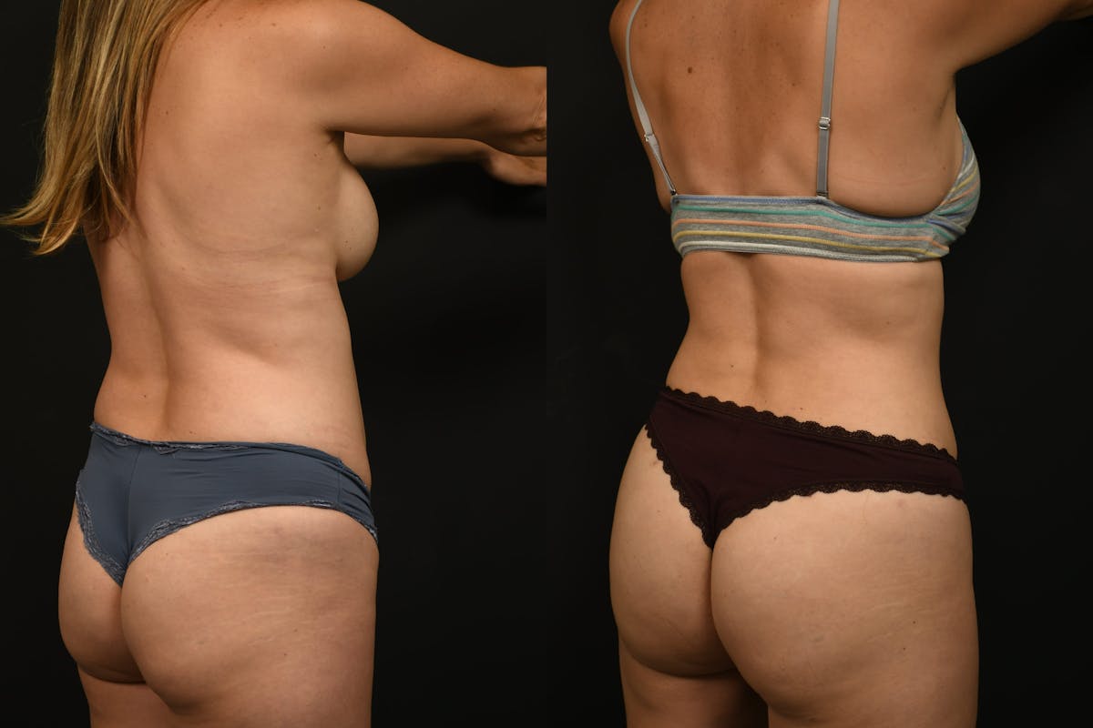 Liposuction / BodyTite Before & After Gallery - Patient 121170 - Image 5