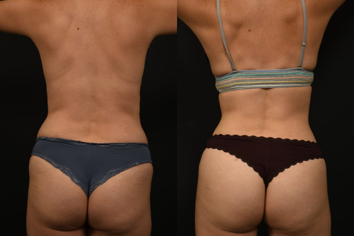 Liposuction / BodyTite Before & After Gallery - Patient 121170 - Image 6