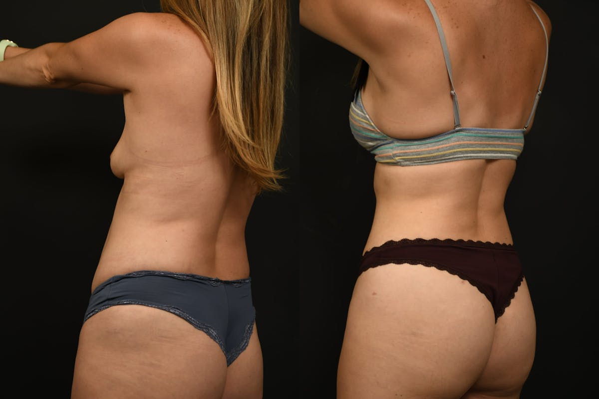 Liposuction / BodyTite Before & After Gallery - Patient 121170 - Image 7