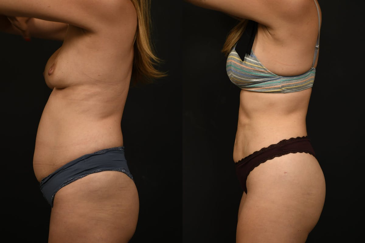 Liposuction / BodyTite Before & After Gallery - Patient 121170 - Image 2