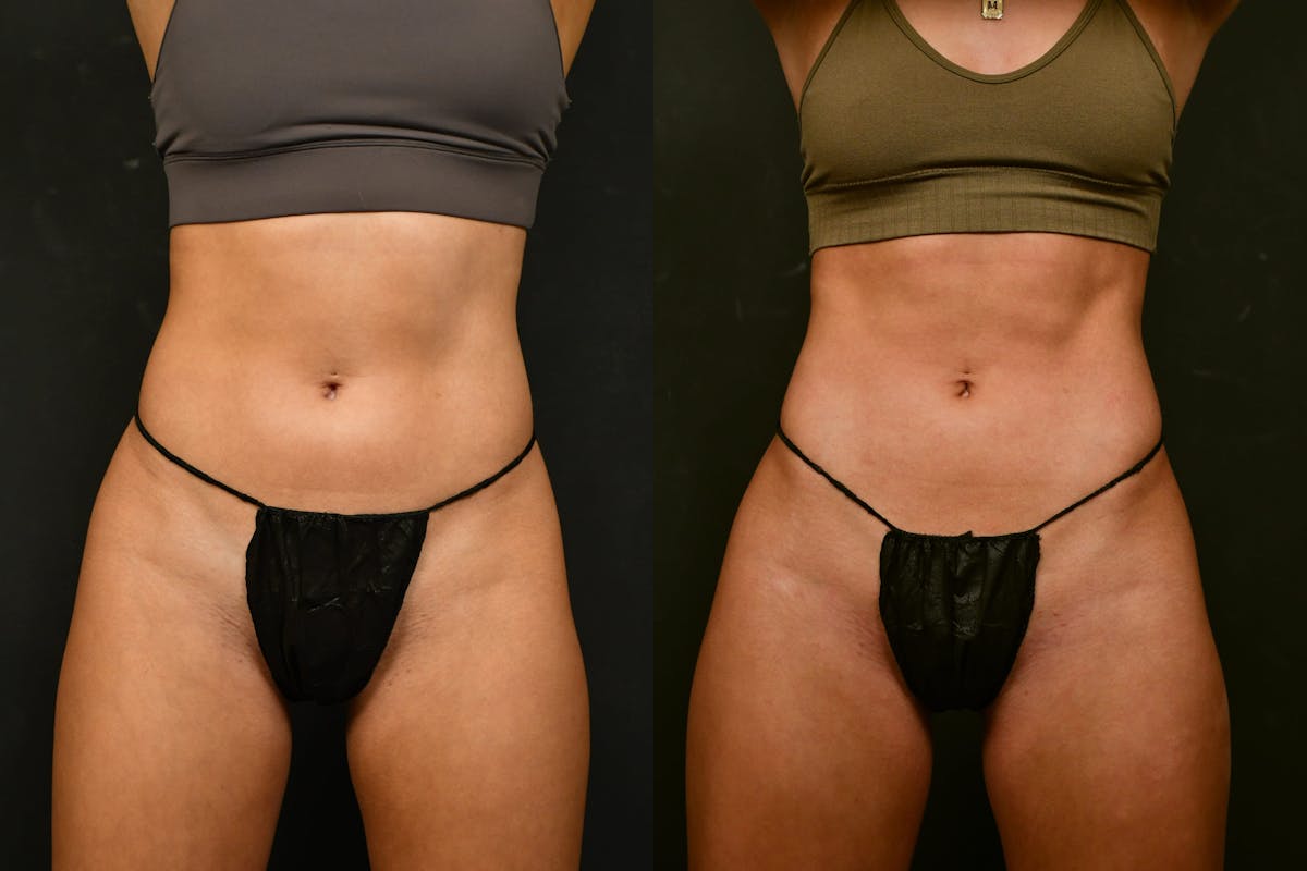 Liposuction / BodyTite Before & After Gallery - Patient 327669 - Image 1
