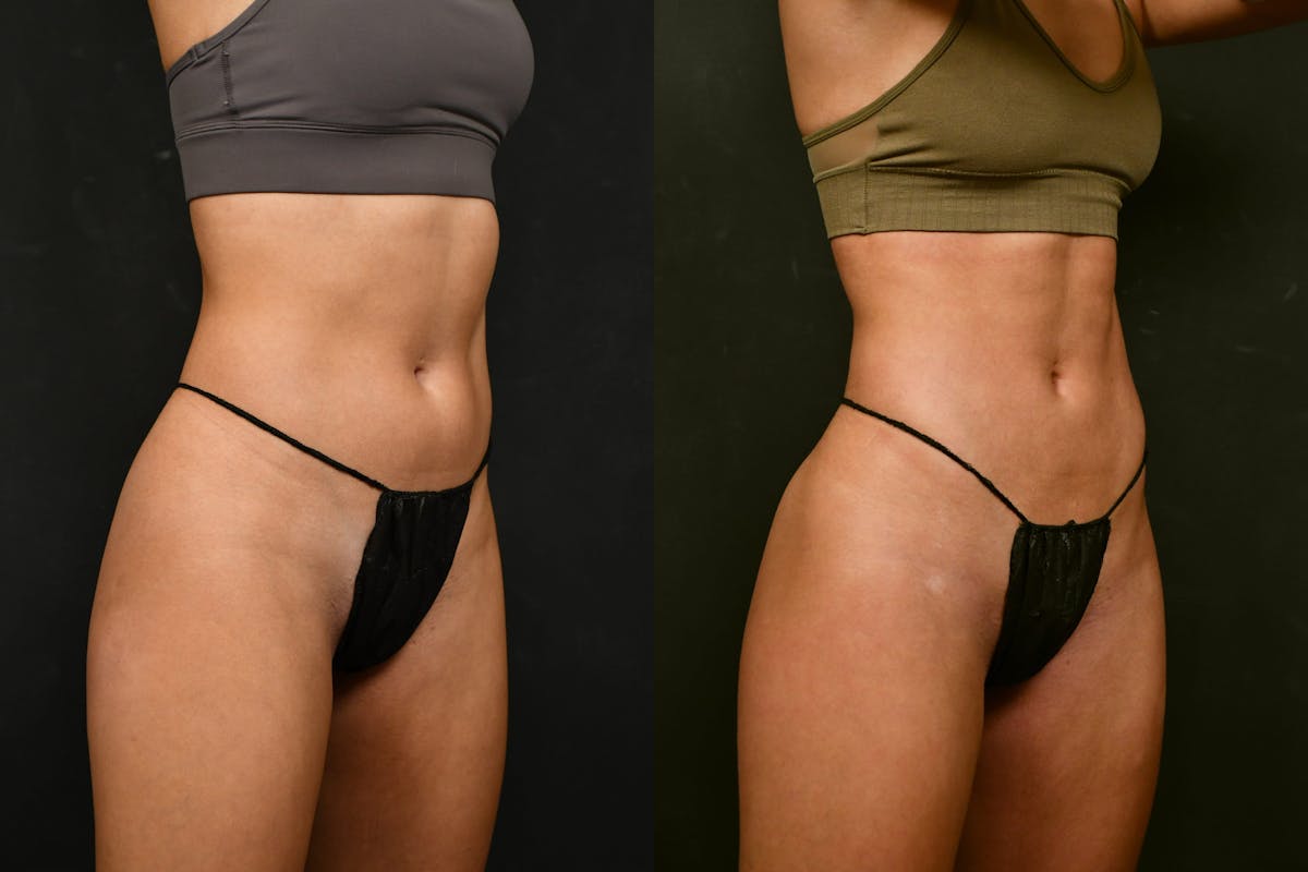 Liposuction Before & After Gallery - Patient 327669 - Image 2