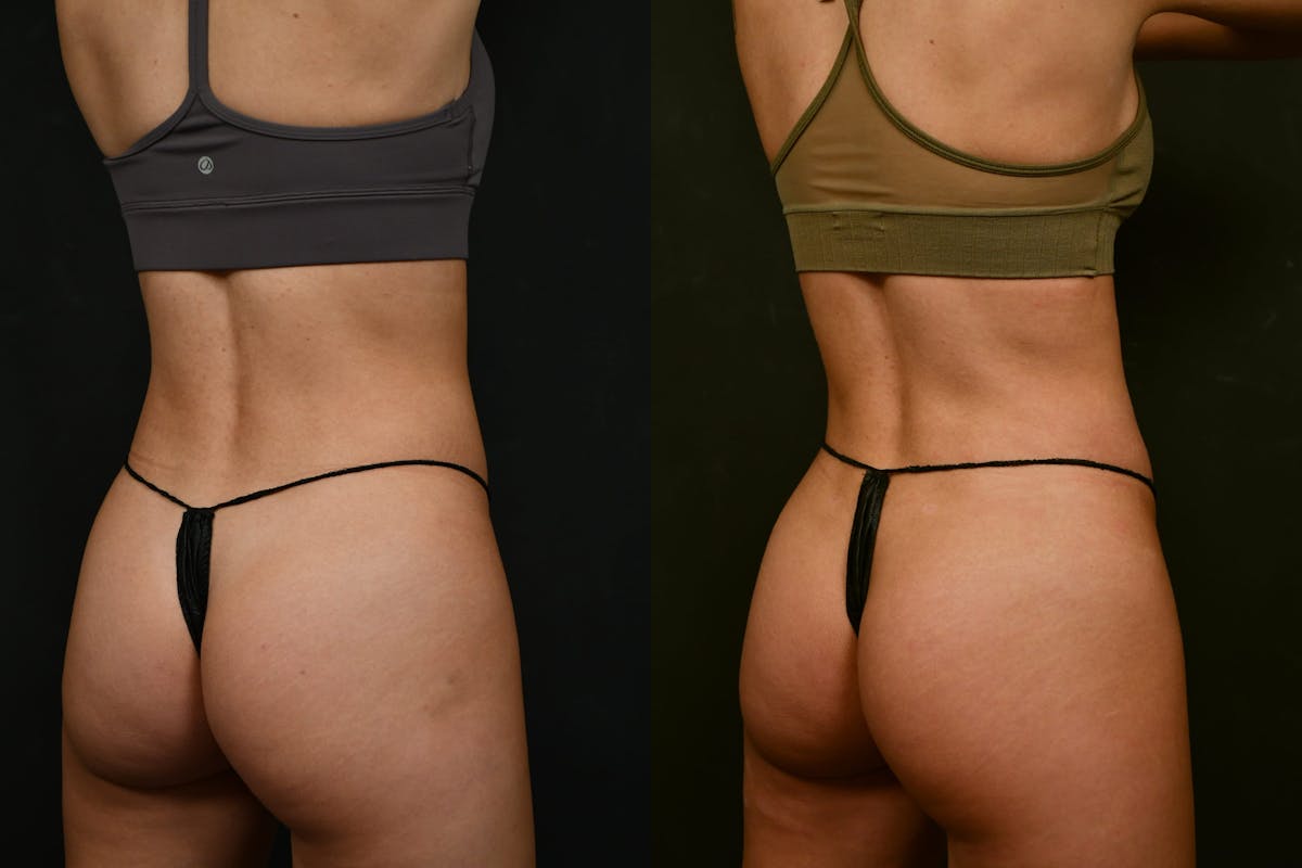 Liposuction Before & After Gallery - Patient 327669 - Image 6