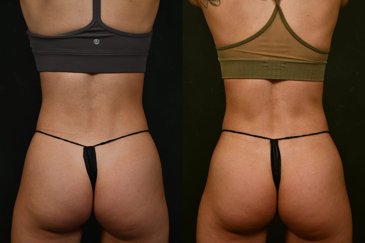 Liposuction / BodyTite Before & After Gallery - Patient 327669 - Image 7