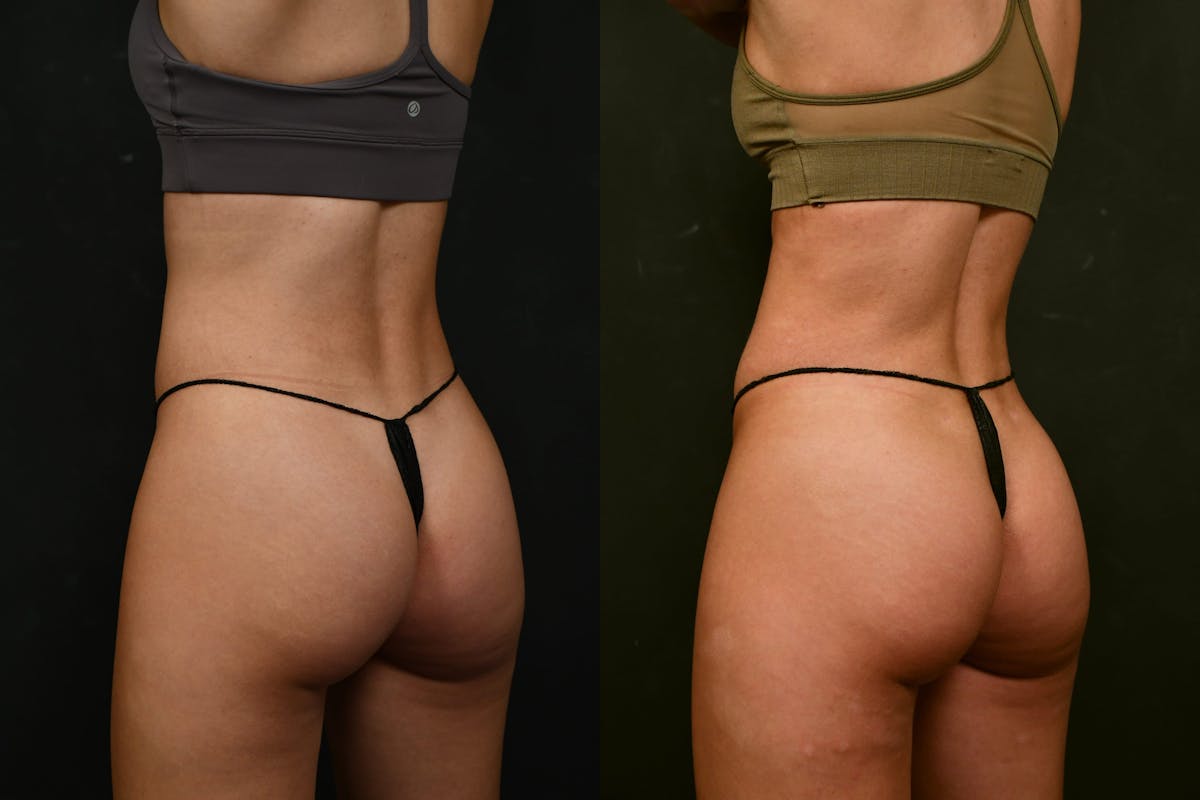 Liposuction / BodyTite Before & After Gallery - Patient 327669 - Image 8