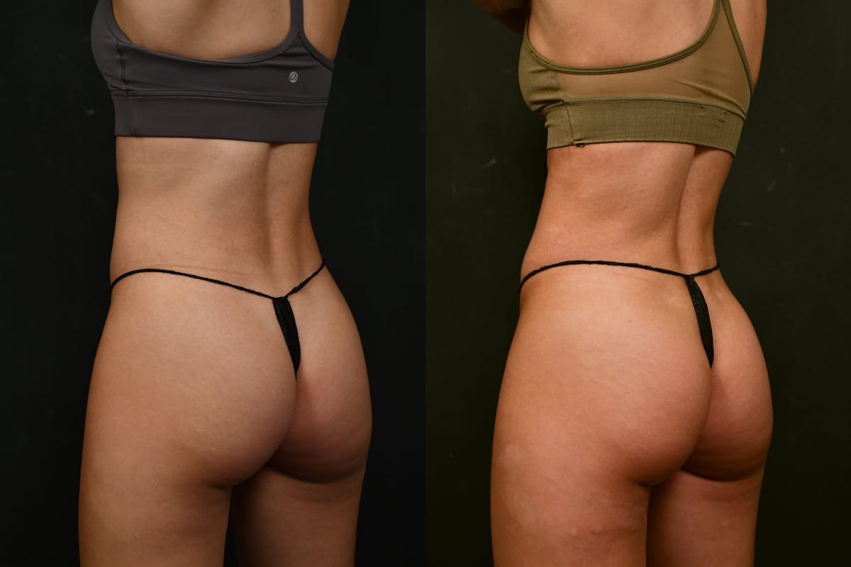 Liposuction Before & After Gallery - Patient 327669 - Image 8