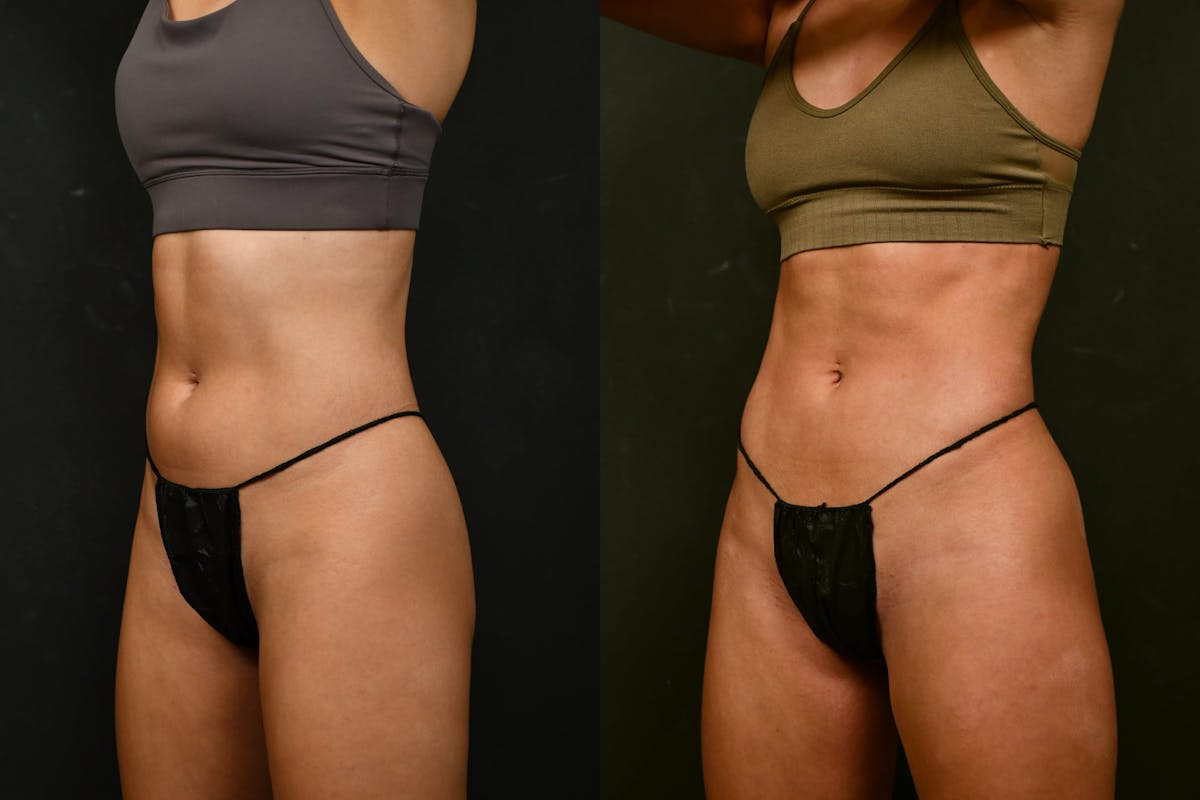 Liposuction / BodyTite Before & After Gallery - Patient 327669 - Image 4