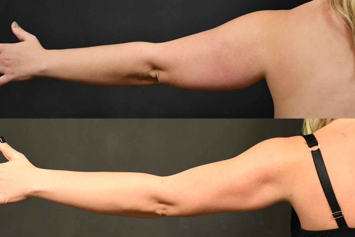 Liposuction / BodyTite Before & After Gallery - Patient 139555 - Image 2
