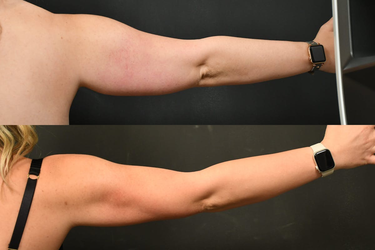 Liposuction / BodyTite Before & After Gallery - Patient 139555 - Image 3