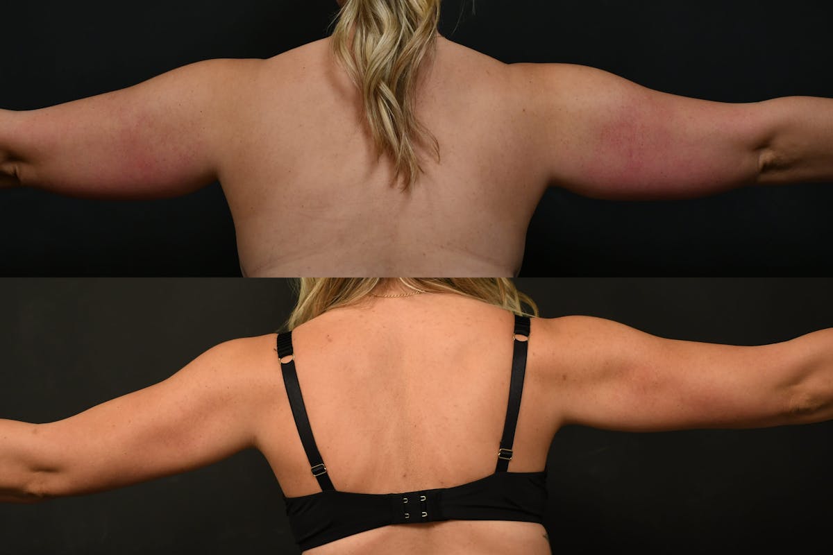 Liposuction / BodyTite Before & After Gallery - Patient 139555 - Image 1
