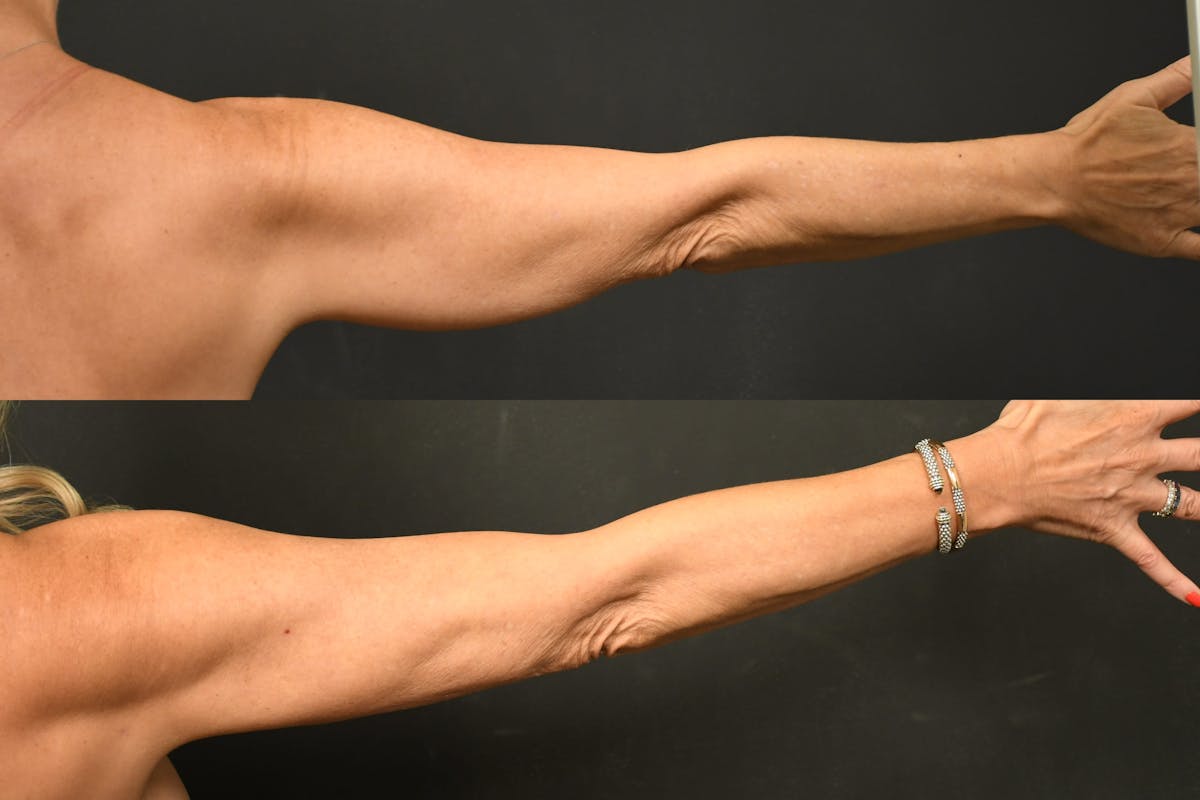 Liposuction Before & After Gallery - Patient 411510 - Image 3