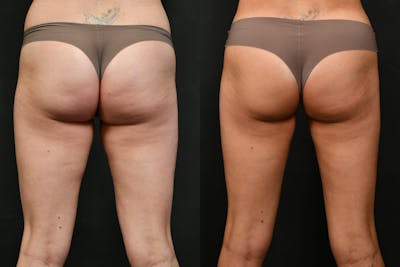 BodyTite - Thigh Before & After Gallery - Patient 226560 - Image 1