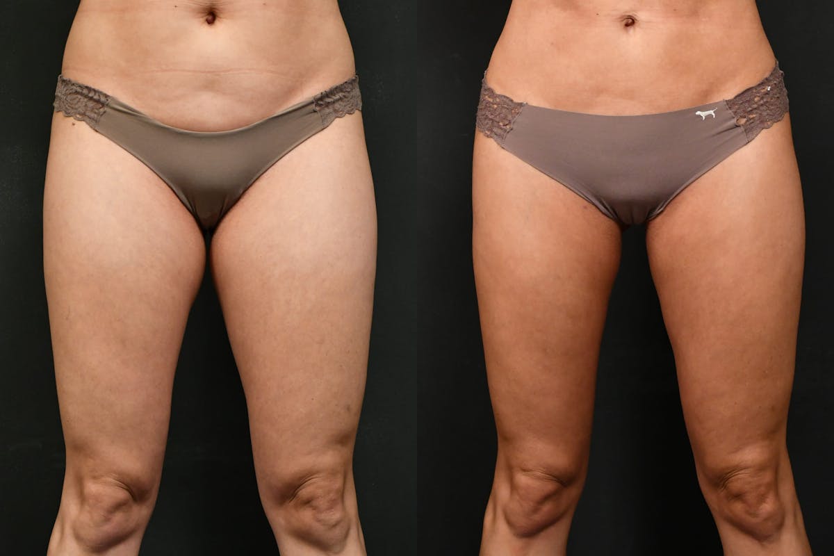 BodyTite - Thigh Before & After Gallery - Patient 226560 - Image 2