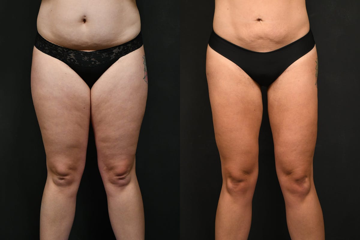BodyTite - Thigh Before & After Gallery - Patient 213531 - Image 2