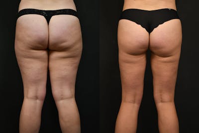 Liposuction / BodyTite Before & After Gallery - Patient 242944 - Image 1