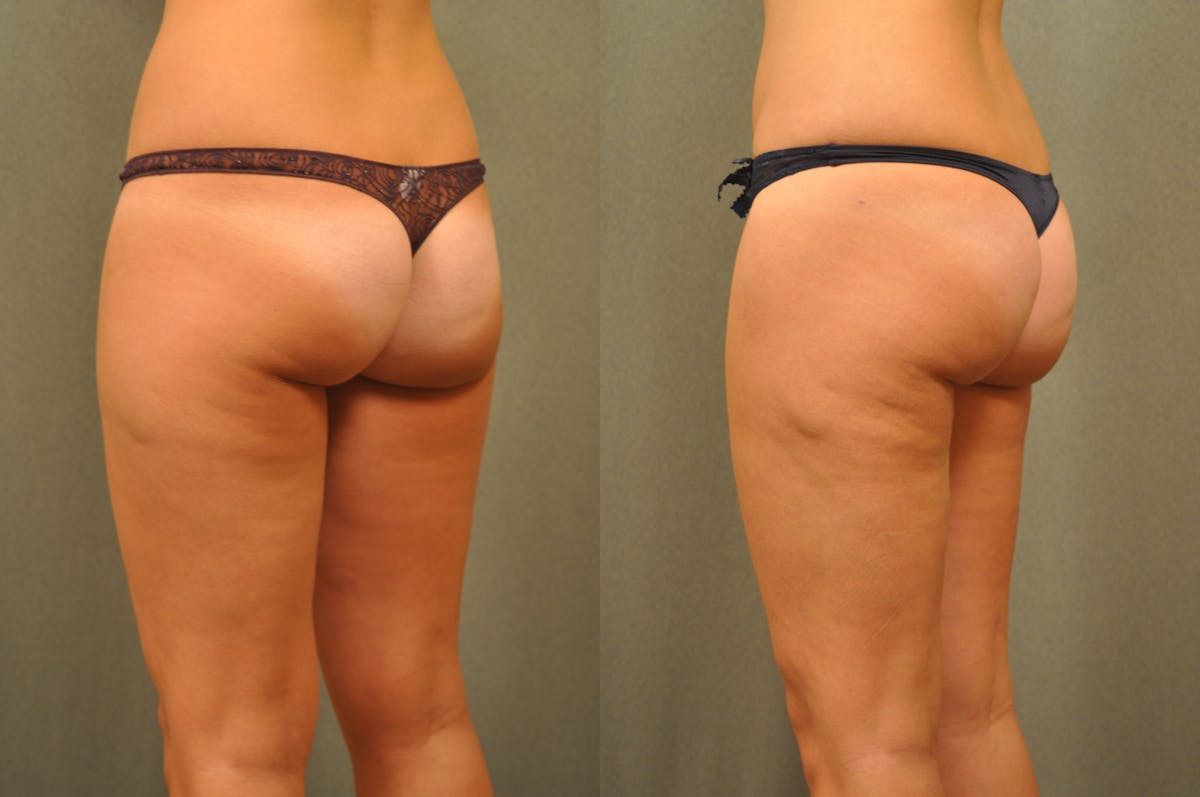 BodyTite - Thigh Before & After Gallery - Patient 172658 - Image 3