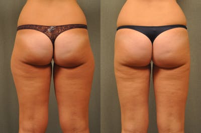 BodyTite - Thigh Before & After Gallery - Patient 172658 - Image 1