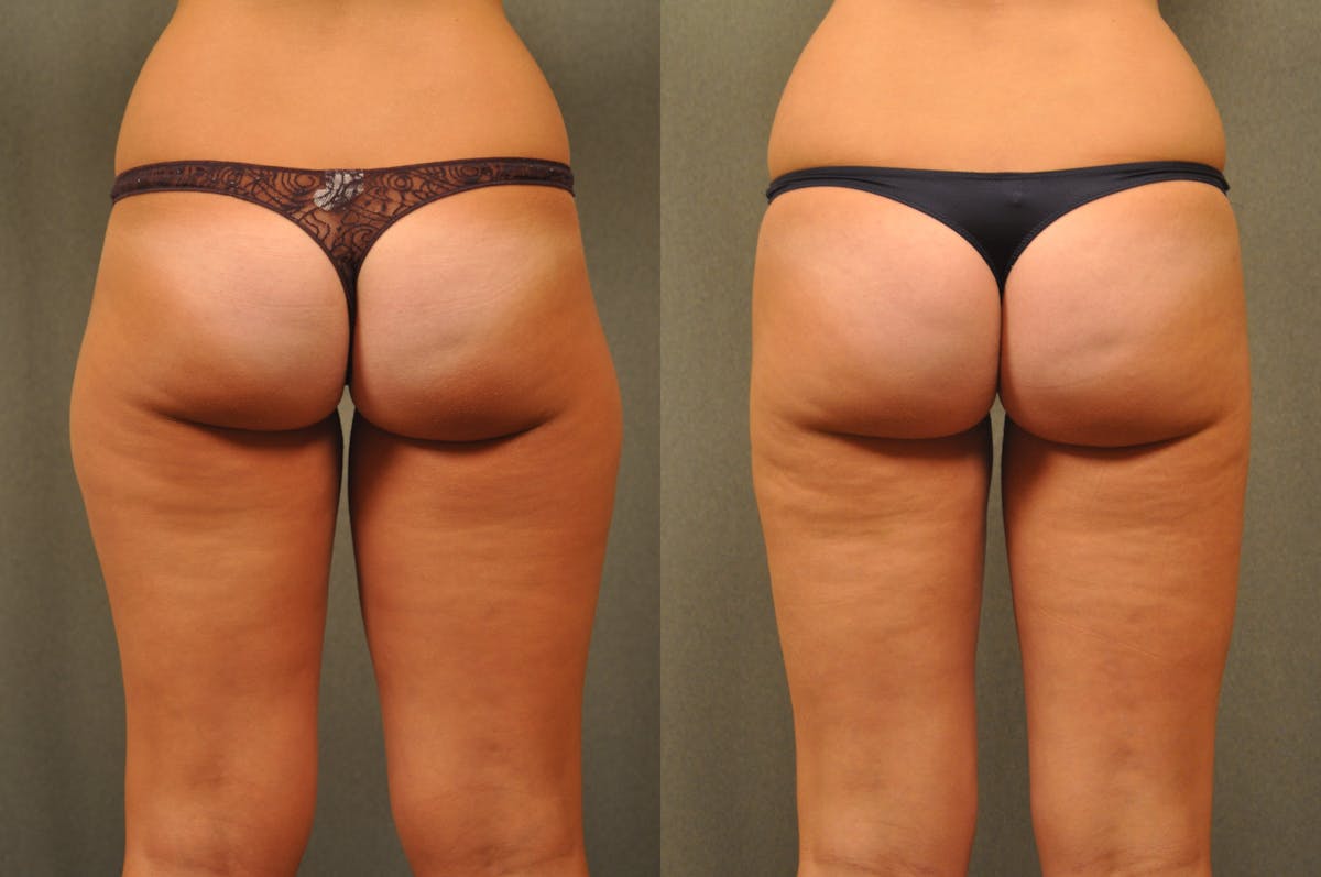 BodyTite - Thigh Before & After Gallery - Patient 172658 - Image 1