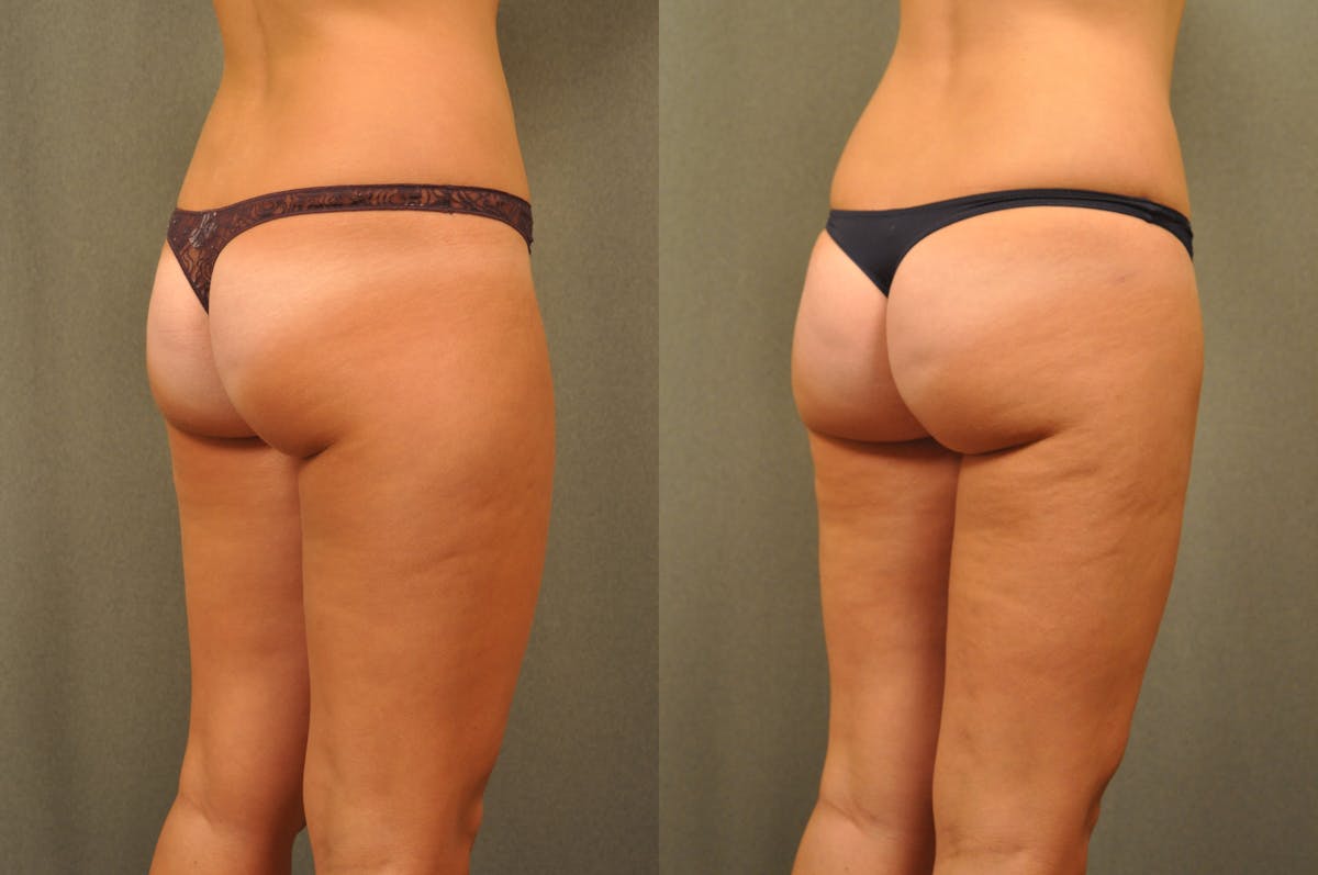 BodyTite - Thigh Before & After Gallery - Patient 172658 - Image 4