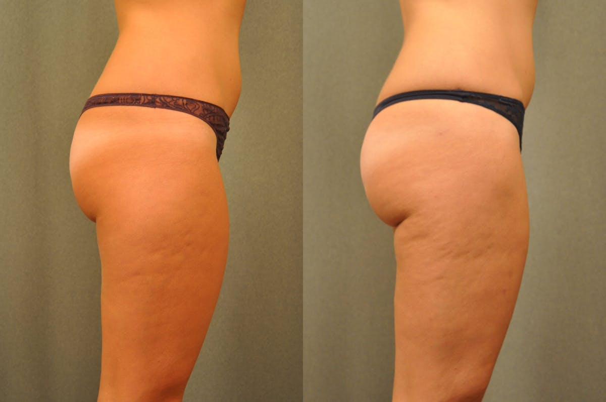 BodyTite - Thigh Before & After Gallery - Patient 172658 - Image 5