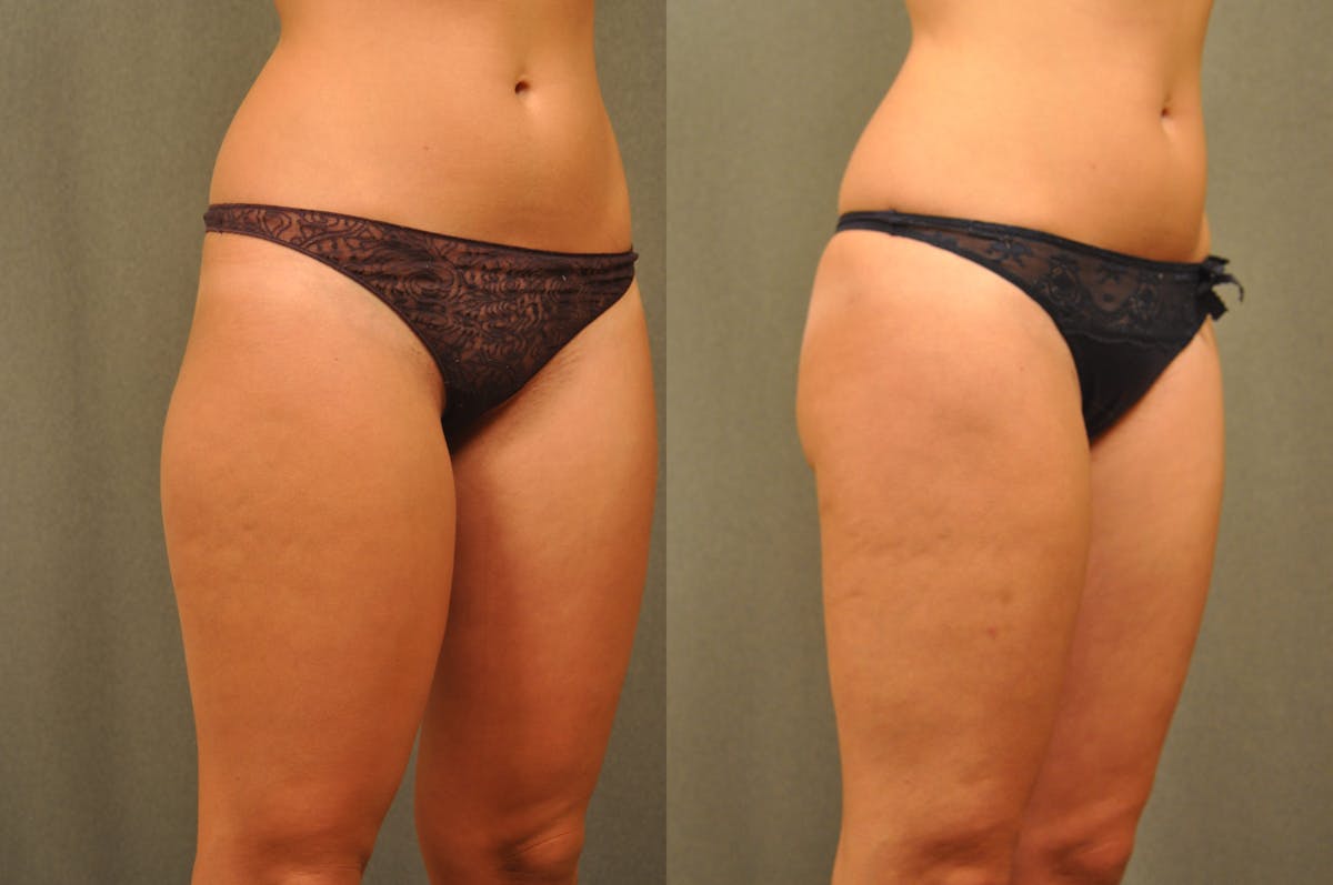 BodyTite - Thigh Before & After Gallery - Patient 172658 - Image 6
