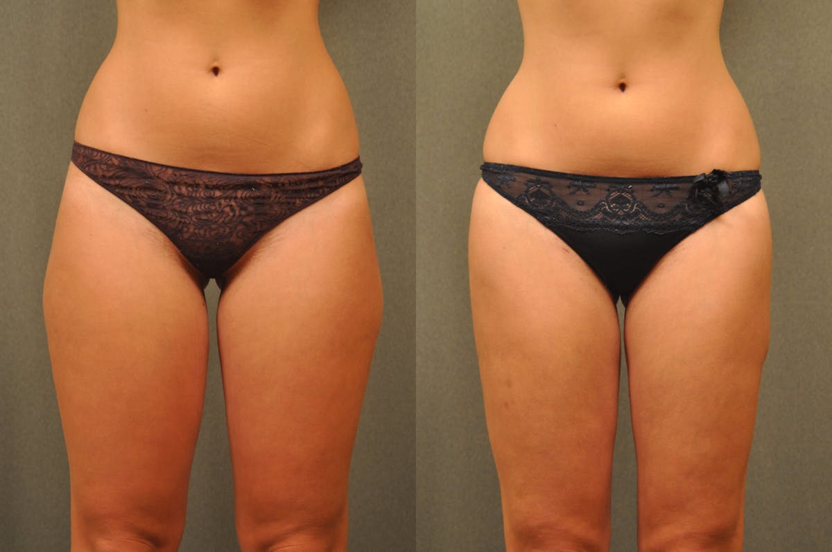 BodyTite - Thigh Before & After Gallery - Patient 172658 - Image 2