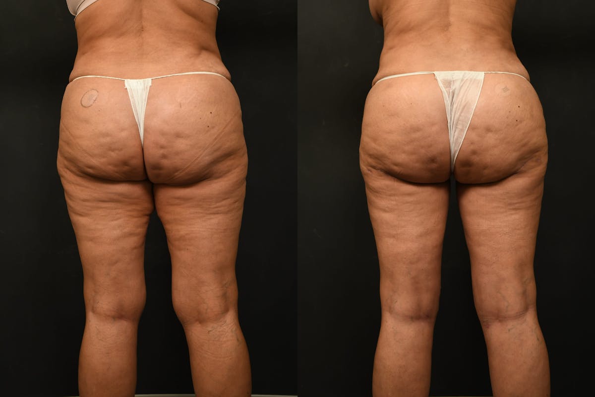Thigh Lift Before & After Gallery - Patient 504163 - Image 2
