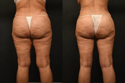 Thigh Lift Before & After Gallery - Patient 504163 - Image 1