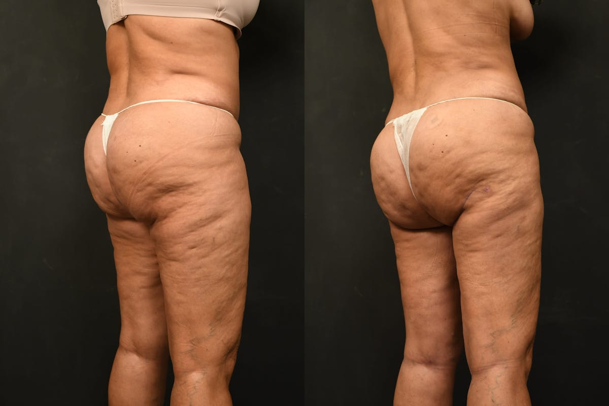 Thigh Lift Before & After Gallery - Patient 504163 - Image 3