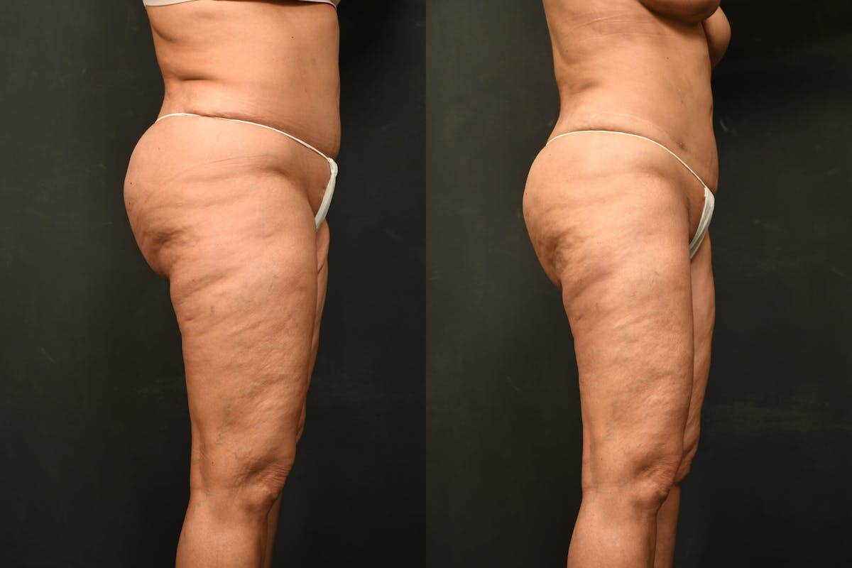 Thigh Lift Before & After Gallery - Patient 504163 - Image 4