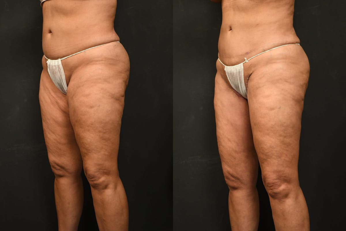 Thigh Lift Before & After Gallery - Patient 504163 - Image 5