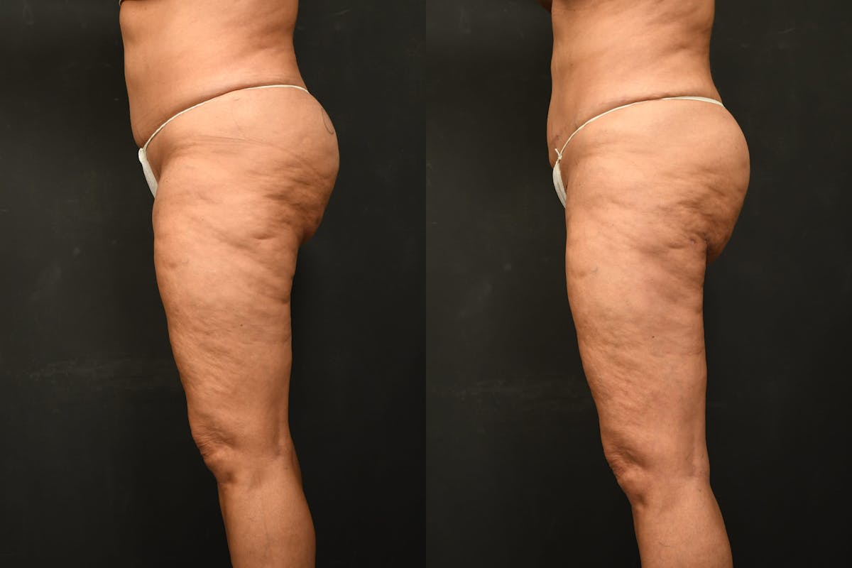 Thigh Lift Before & After Gallery - Patient 504163 - Image 6