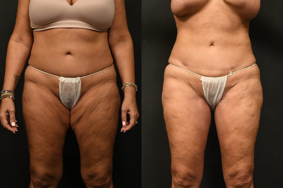 Thigh Lift Before & After Gallery - Patient 504163 - Image 1