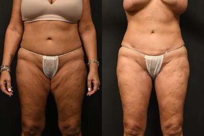 Thigh Lift Before & After Gallery - Patient 504163 - Image 1