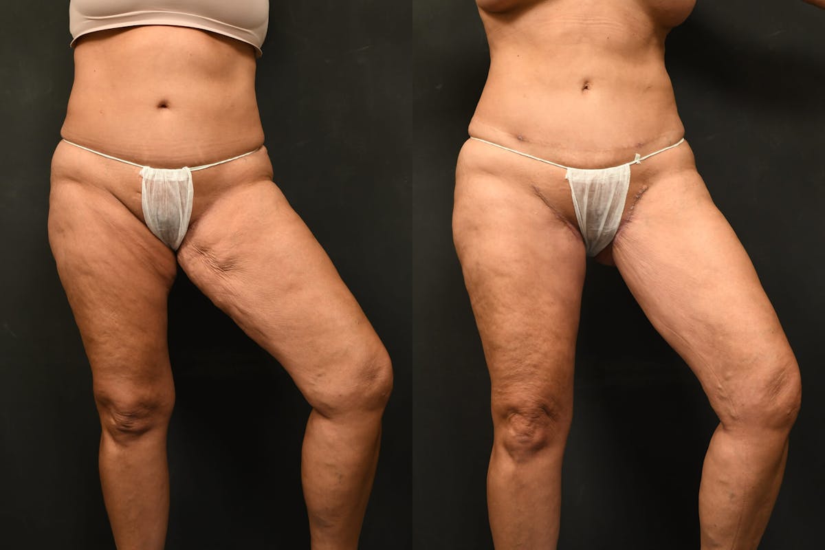Thigh Lift Before & After Gallery - Patient 504163 - Image 7