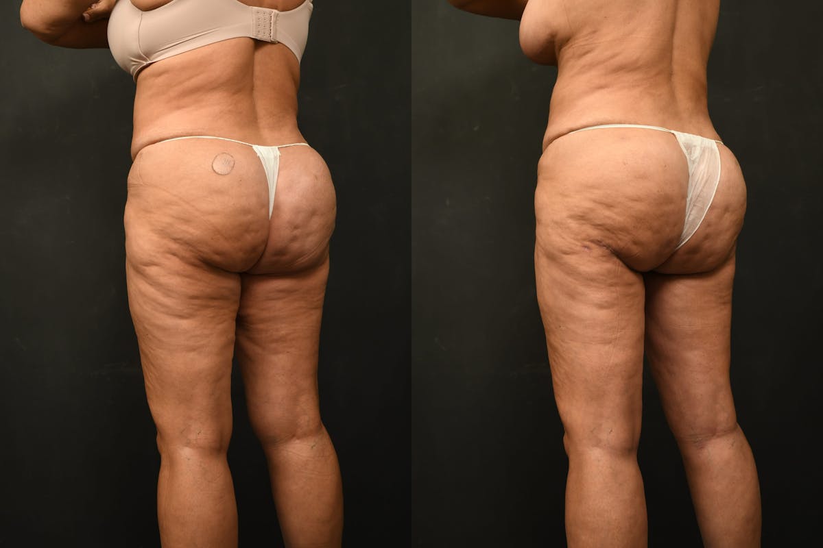 Thigh Lift Before & After Gallery - Patient 504163 - Image 8