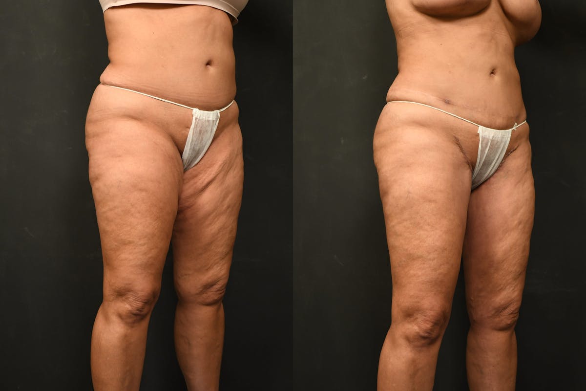 Thigh Lift Before & After Gallery - Patient 504163 - Image 9