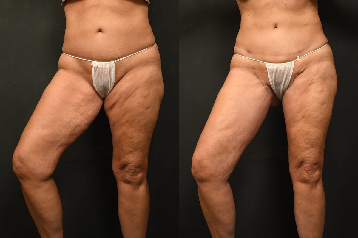 Thigh Lift Before & After Gallery - Patient 504163 - Image 10