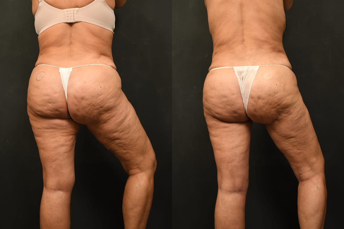 Thigh Lift Before & After Gallery - Patient 504163 - Image 11