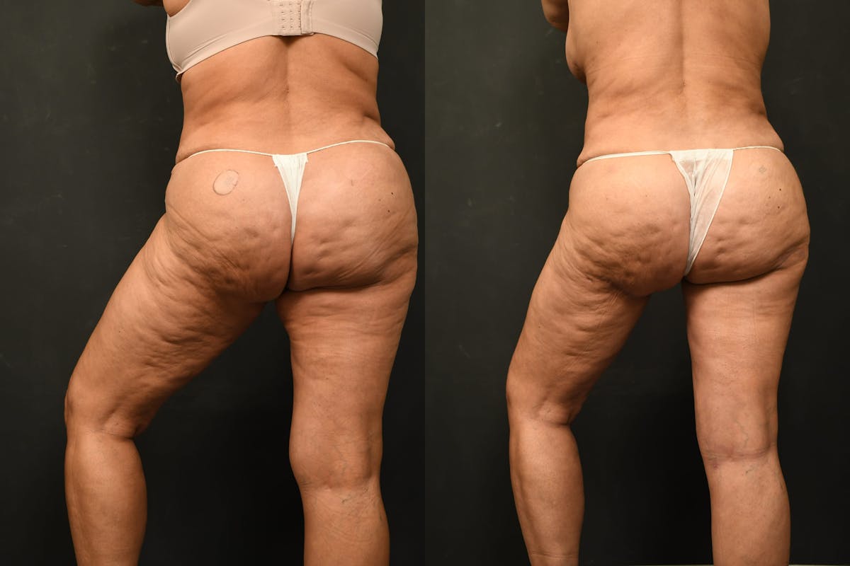 Thigh Lift Before & After Gallery - Patient 504163 - Image 12
