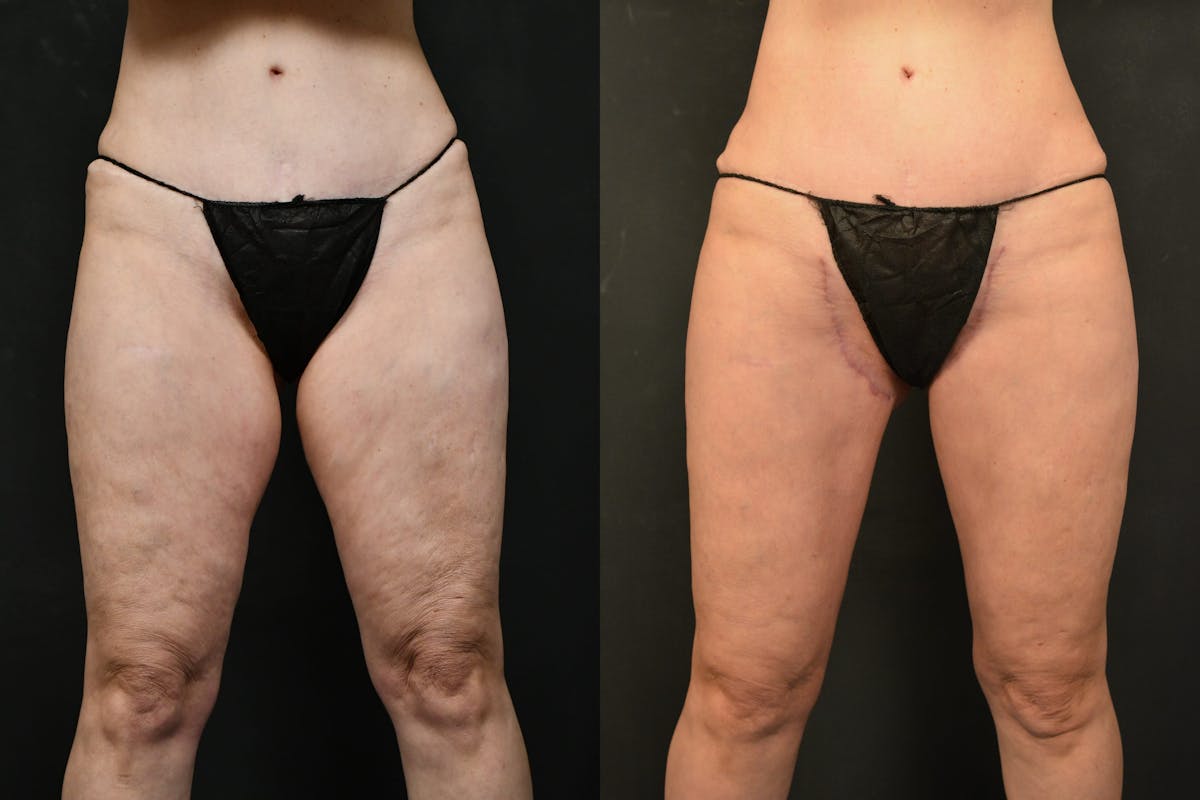 Thigh Lift Before & After Gallery - Patient 383114 - Image 2