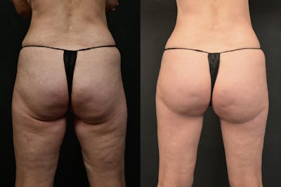 Thigh Lift Before & After Gallery - Patient 383114 - Image 1