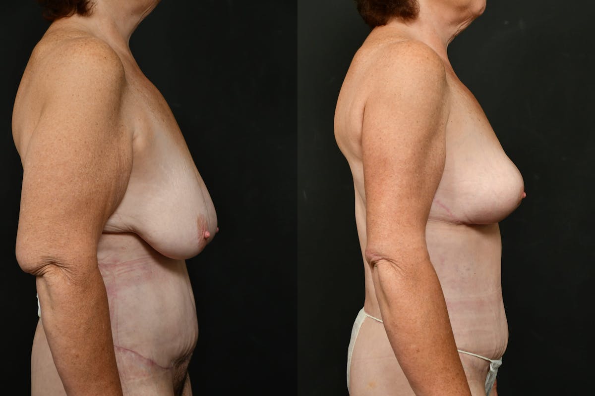 Non-Surgical Before & After Gallery - Patient 126798 - Image 1
