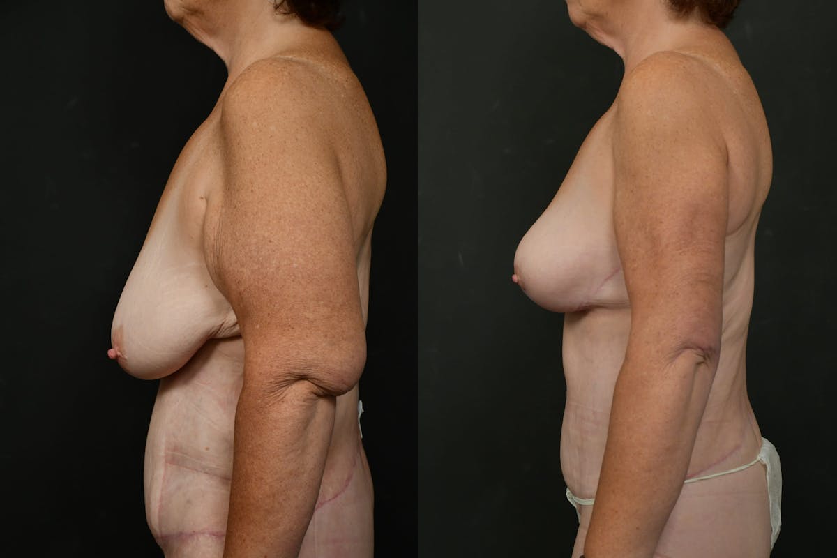Non-Surgical Before & After Gallery - Patient 126798 - Image 3