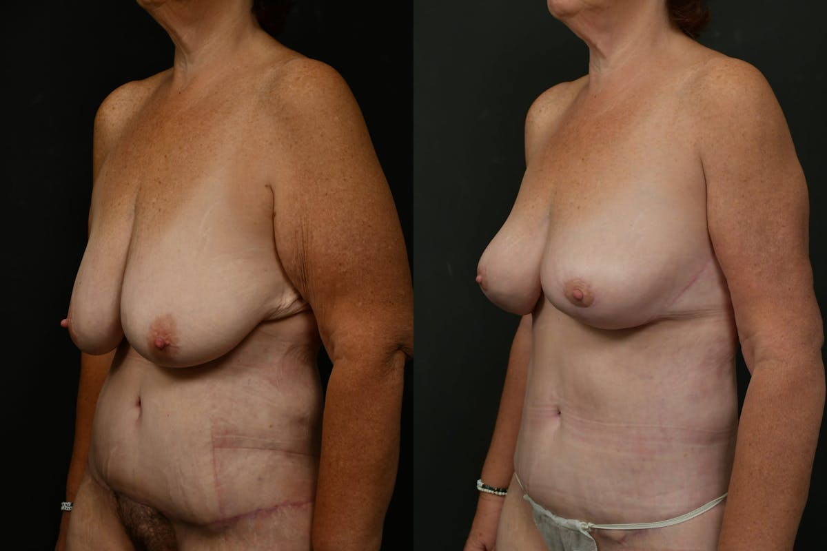 Non-Surgical Before & After Gallery - Patient 126798 - Image 4